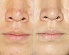 Photodynamic Therapy before & after photos