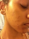 Now after 2 years of struggling with acne..I have a lot of scars and new pimples appearing everyday