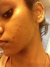 There's many hidden cysts under the skin..I feel the bump when I was my face..
I have alot of whiteheads on my chin and nose too.