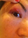 My right eye with the swollen lump