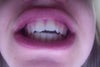 my overbite