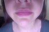 face looks puffy and swollen. My face is usually a slim oval shape but since the TMJ looks squared and masculine.