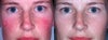 Rosacea Treatment Before and After Photos