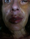 Lip Augmentation see over swelling on lower lip
