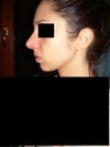 nose after rhinoplasty