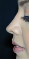 Morph of how nose would looklook post op