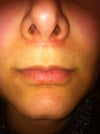 result & scar after 6 months.