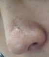 Nose lowered scar.