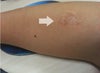 Arm raised scar.