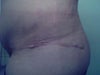Flap on the incision line above my hip.