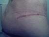 This side has the stitch that is still seen and felt externally. I can also sometimes feel the end as it jabs me from the inside.