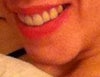 Witchs Chin Deformity?