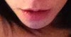 Uneven chin line... more swollen on left side