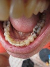 nothing left to shape and prep on half the tooth - how to attach a crown?