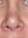 Front post op