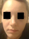 about 5 months post op, nose is crooked