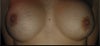 Before, these were 425cc's with a mild CC, I think my current larger implants may have exaggerated the asymmetry.