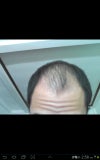 my hair now