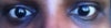 Darker eye After Co2 laser