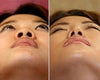 Asian Rhinoplasty before & after photos