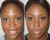 African American Rhinoplasty before & after photos