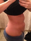 2weeks after. there is a double bulge and both are hard.