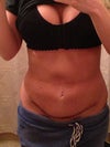 2 weeks after. it is not flat at all and worse than before the surgery.