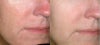 LED Skin Treatment before & after photos