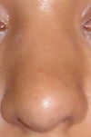 The front view 8 months after surgery.