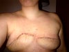 most mastectomy 150cc salline tissue expanders
