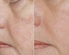 Yag laser before & after photos