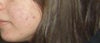 scars and redness