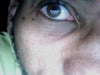 small growth under eye