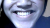 My unsymmetrical smile lines.