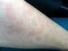 Immediately after 1st treatment