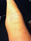 Burns 1 week after treatment