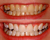 Zoom whitening before & after photos