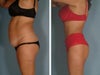 This is not me but the before is pretty similar to my stomach