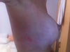 Initial rash