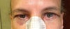 7 days after operation. Did he over tighten the RH side. Do you think the natural shape will return in 2-3 months?