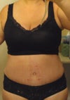3 weeks post op.