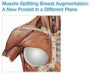 Split muscle technique where there is only upper pole muscle coverage on implant