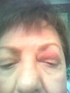 Note swollen eyes