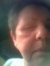 Whole face swollen