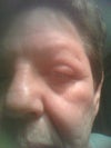 More swelling--