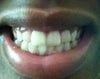 This is a picture of how my teeth look. Hopefully this can help you answer the questions.