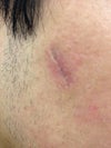 Dented scar
