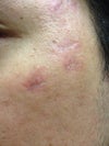 More dented scars from excision