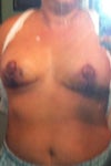 4 days post op