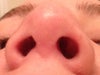 Uneven nostrils! I think i still have stitches on the sides of the tip